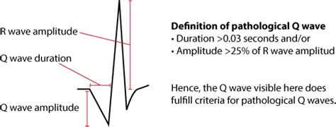 The QRS complex: ECG features of the Q-wave, R-wave, S-wave & duration