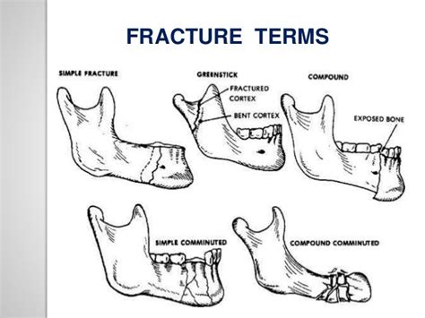 Classification of mandible fracture