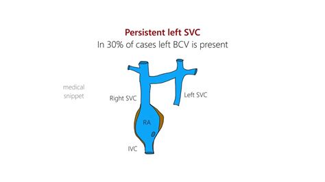 Persistent Left Superior Vena Cava (Left SVC) | Embryology and Clinical ...