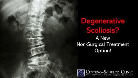 Degenerative Scoliosis? Exciting New Non-surgical Treatment Option