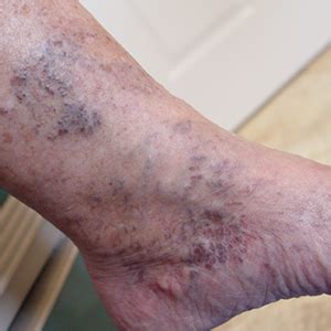 Venous Stasis Dermatitis Treatment | Muto Vein Center