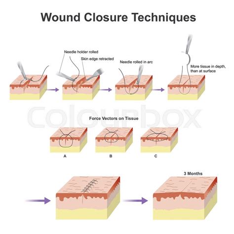 A wound is a type of injury which ... | Stock image | Colourbox