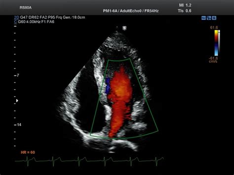 Ultrasound images • Heart (apical 4 chamber view), color doppler ...