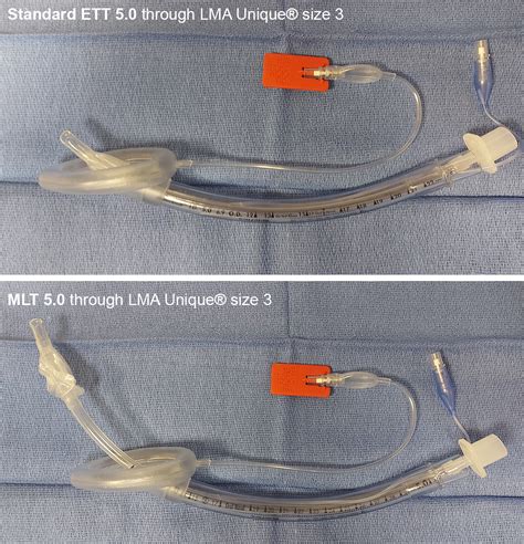 Intubation through an SGA | Anesthesia Airway Management (AAM)