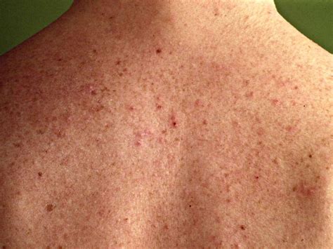 Folliculitis: Folliculitis Causes, Symptoms & Treatments