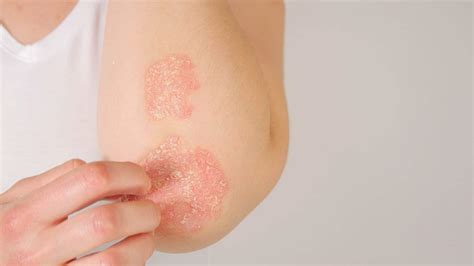 Skin Condition of the Month: Psoriasis