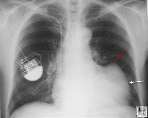 Lv Apical Aneurysm Ecg