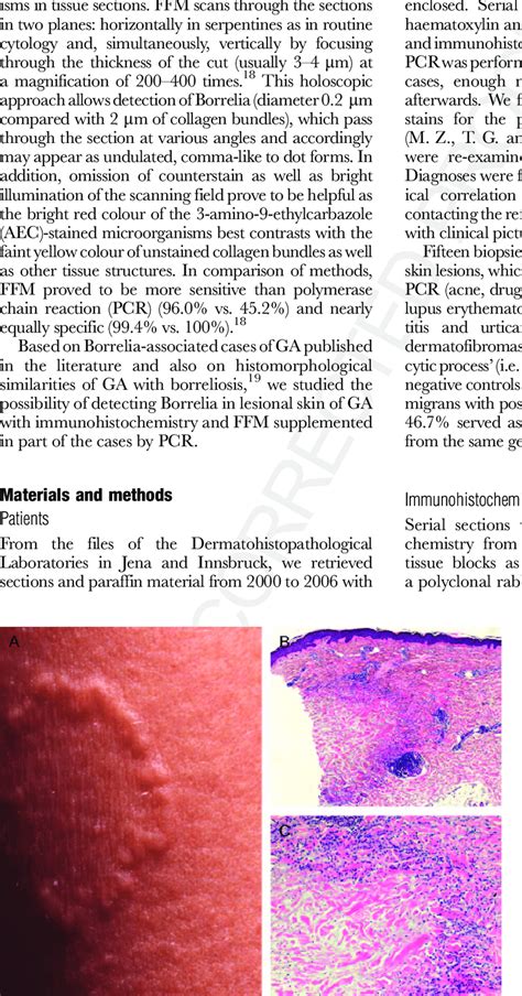 Classic localized granuloma annulare. A) Clinical picture. B ...