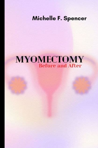 Myomectomy, before and after by Michelle F. Spencer, Paperback | Barnes ...