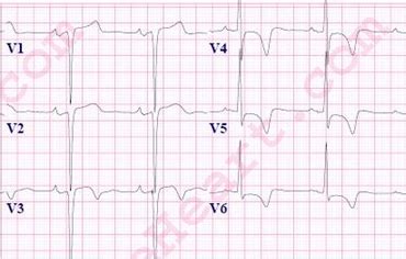 Left Ventricular Hypertrophy (LVH) ECG Review | Learn the Heart