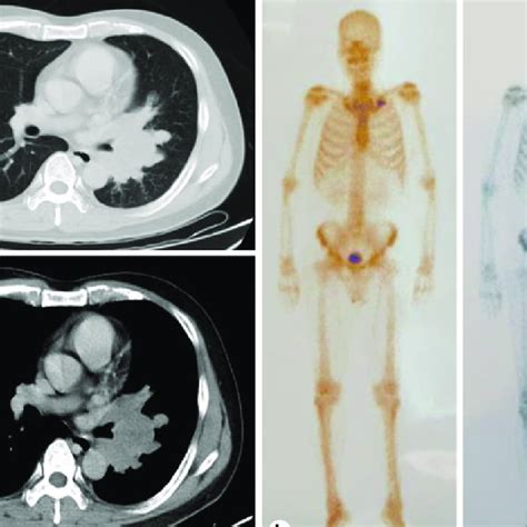 Imaging results from initial hospitalization. a Chest CT shows a left ...