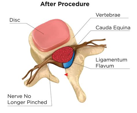 Laminectomy | BioSpine Institute