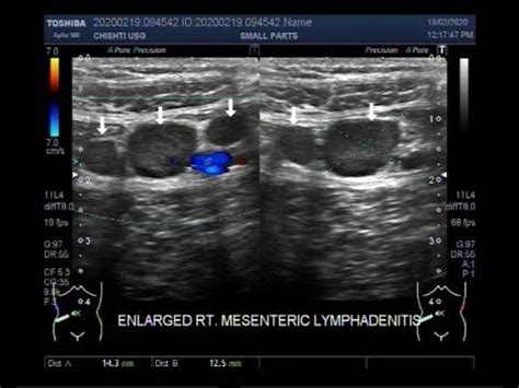 Ultrasound Video showing Mesenteric lymphadenitis, enlarged mesenteric ...