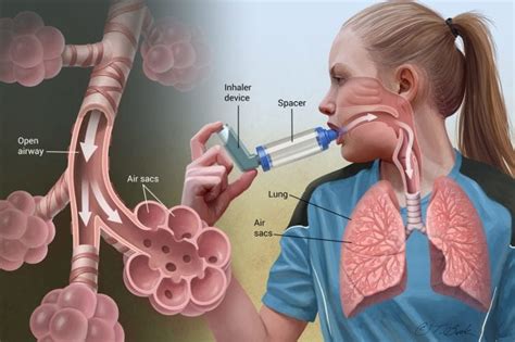 How to Treat Asthma Attacks Without an Inhaler (By Preventing Them Instead)