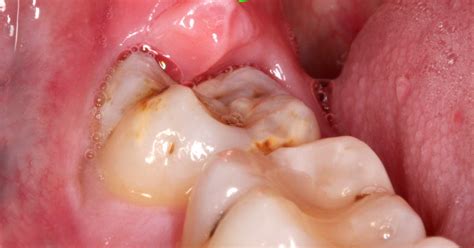 Wisdom Tooth Infection | Dental Dentist