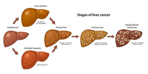 Stages of Liver Cancer | CyberKnife Treatment Center Miami