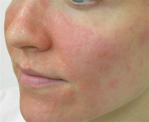 Facial Eczema: Triggers and Dealing Methods | New Health Advisor