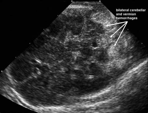 US image of the posterior fossa obtained through the mastoid fontanelle ...