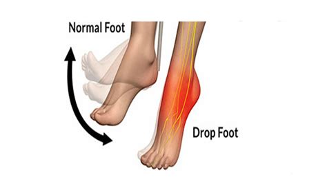 Foot Drop Surgery - Pune Foot Ankle