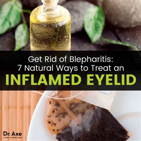 Get Rid of Blepharitis: Natural Remedies