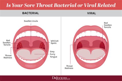 Top 10 Ways to Overcome a Sore Throat - DrJockers.com