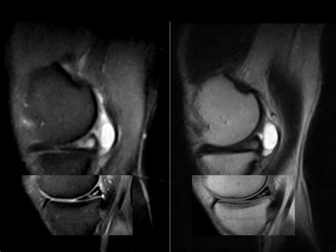 Meniscal Cyst | coachingultrasound