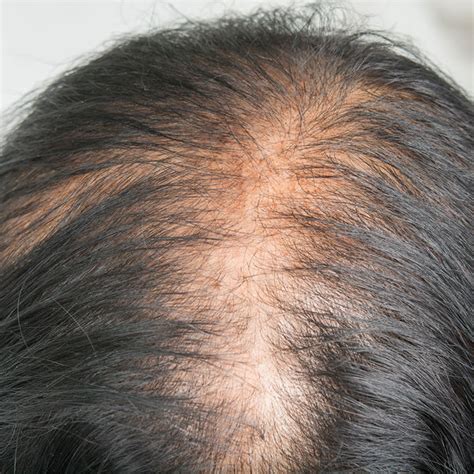 Does PCOS Cause Hair Loss? – Wigs.com