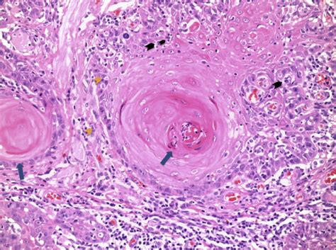 Squamous Cell Carcinoma Histology