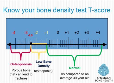 Printable Bone Density Chart