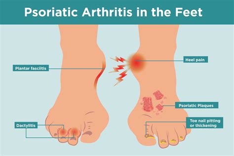 Psoriatic Arthritis In The Feet: Symptoms, Treatment, Home, 40% OFF