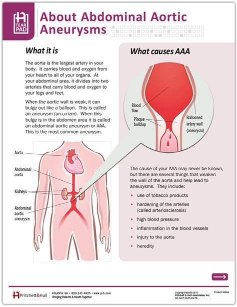 Aortic aneurysm, Medical technology, Abdominal aortic aneurysm