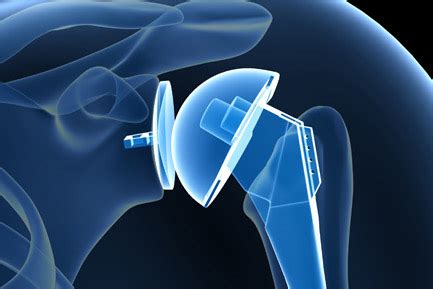 Guide of Joint Replacement Surgery - Health - Get Joys