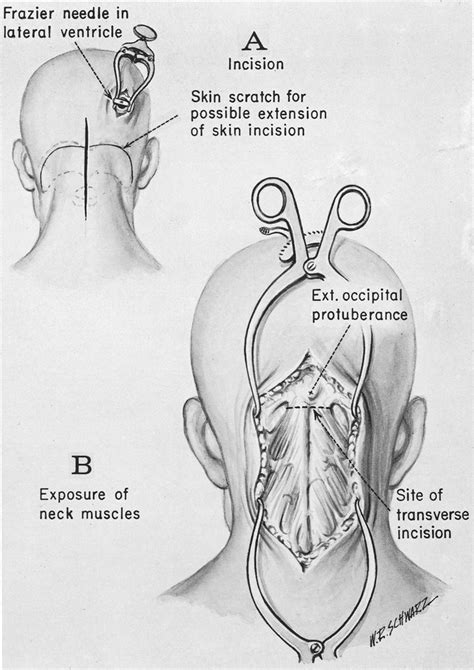 Posterior Cranial Fossa Tumor