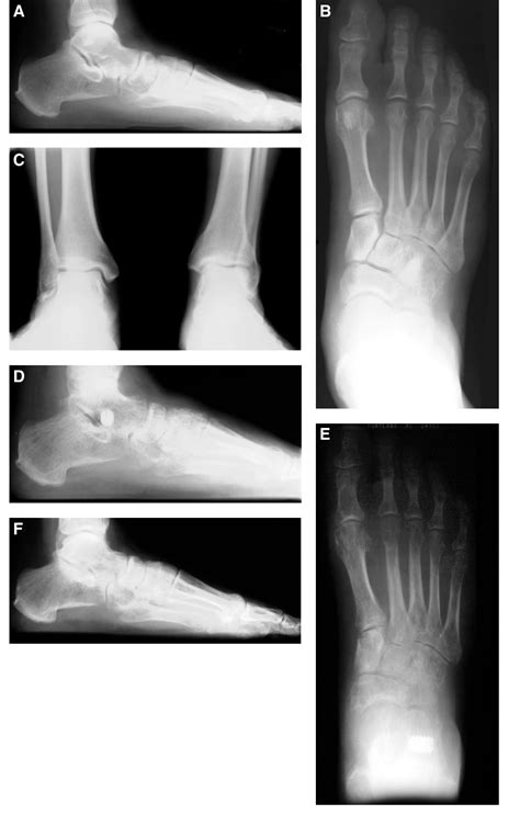 Talipes Calcaneovalgus | Semantic Scholar