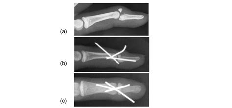 Conservative Treatment of Chronic Mallet Fracture Non-union after ...