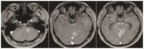 Burkitt lymphoma, a 29-year-old patient. | Download Scientific Diagram