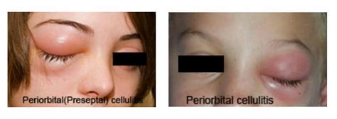 What is Periorbital Cellulitis | Ecellulitis Healthy Living