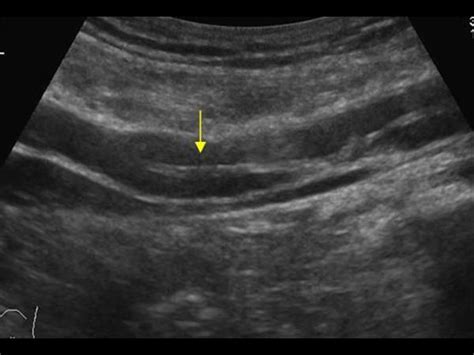 Peripheral vessels | 10.1 Peripheral arteries : Case 10.1.5 Peripheral ...