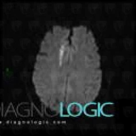 Radiology case : Cerebral infarction (MRI) - Diagnologic