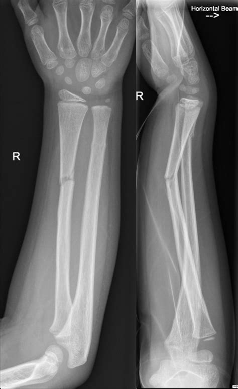 Fractures - Forearm