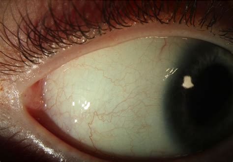 Conjunctival xerosis caused by vitamin A deficiency | Archives of ...