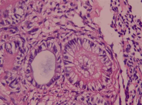 Calcifying Epithelial Odontogenic Tumor Histology