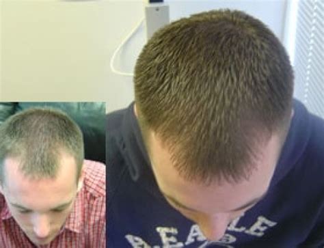 The Benefits of Laser Hair Therapy - Hair Replacement Restoration ...