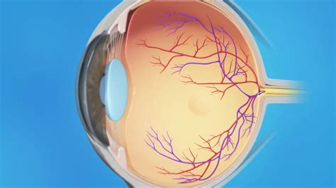 Proliferative Diabetic Retinopathy Treatment - Vitrectomy Surgery - YouTube