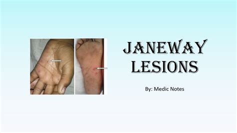 Janeway Lesions