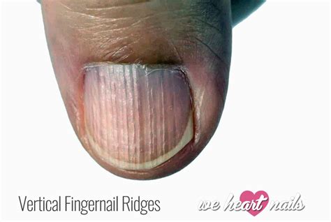 Vertical Ridges on Nails - Causes, Prevention & Treatment