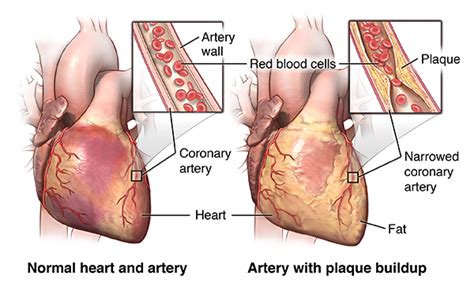 Coronary Artery Bypass Graft Surgery | Johns Hopkins Medicine