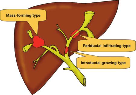 Drawing illustrates the three types of cholangiocarcinoma according to ...