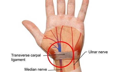 Treatment on the Wrist for Carpal Tunnel Syndrome: Quince Orchard ...