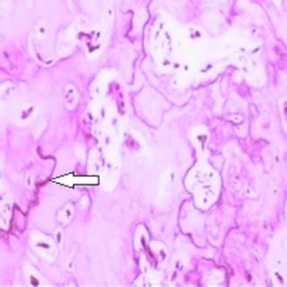 Cementoblastoma Histology